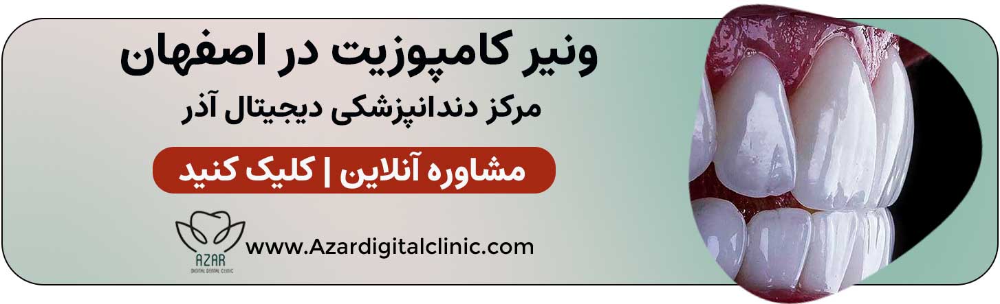 تماس با مرکز ونیر دندانپزشکی دیجیتال آذر در اصفهان | ونیر کامپوزیت در اصفهان