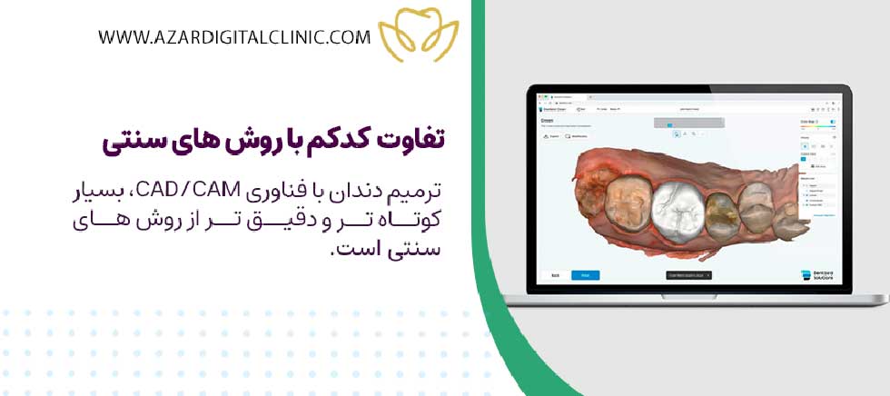 تفاوت فناوری کدکم در دندانپزشکی با سایر روش ها | مرکز دندانپزشکی زیبایی آذر