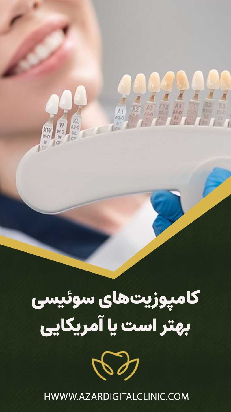 ونير كامپوزيت دندان سوئيسی بهتر است يا آمريكايی؟