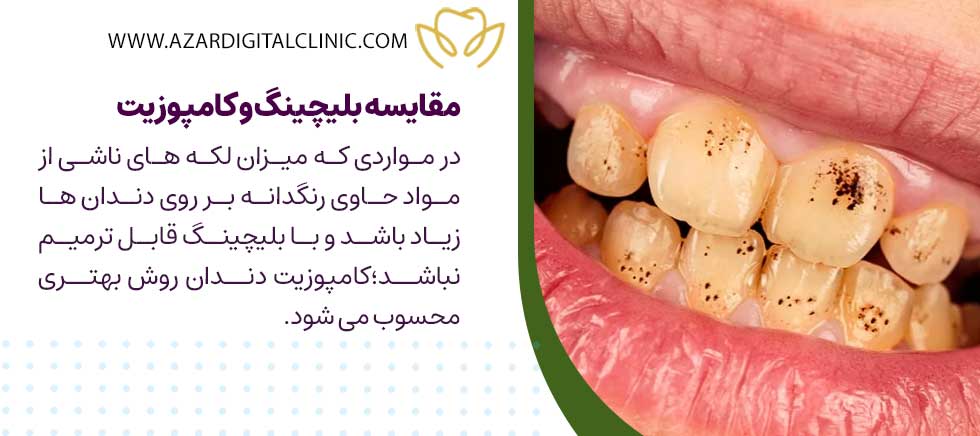 مقایسه بلیچینگ و کامپوزیت از نظر کاربرد