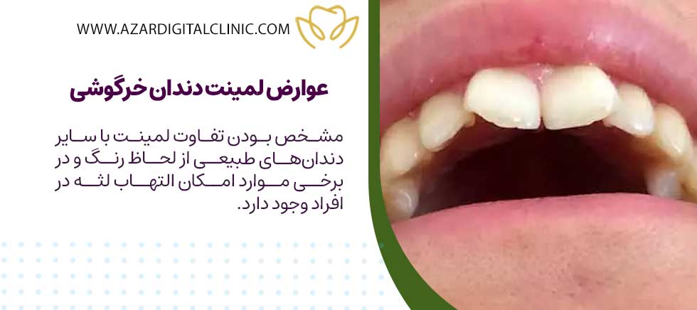 عوارض لمینت دندان خرگوشی
