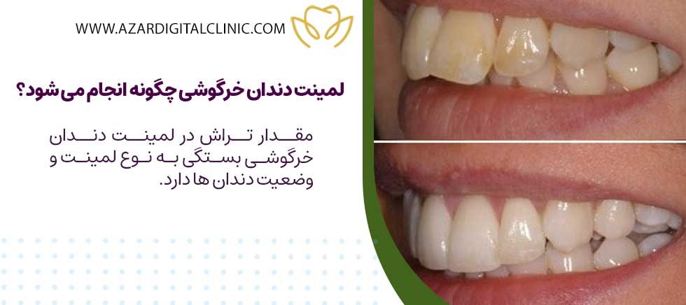 لمینت دندان‌ خرگوشی چگونه انجام می‌ شود؟