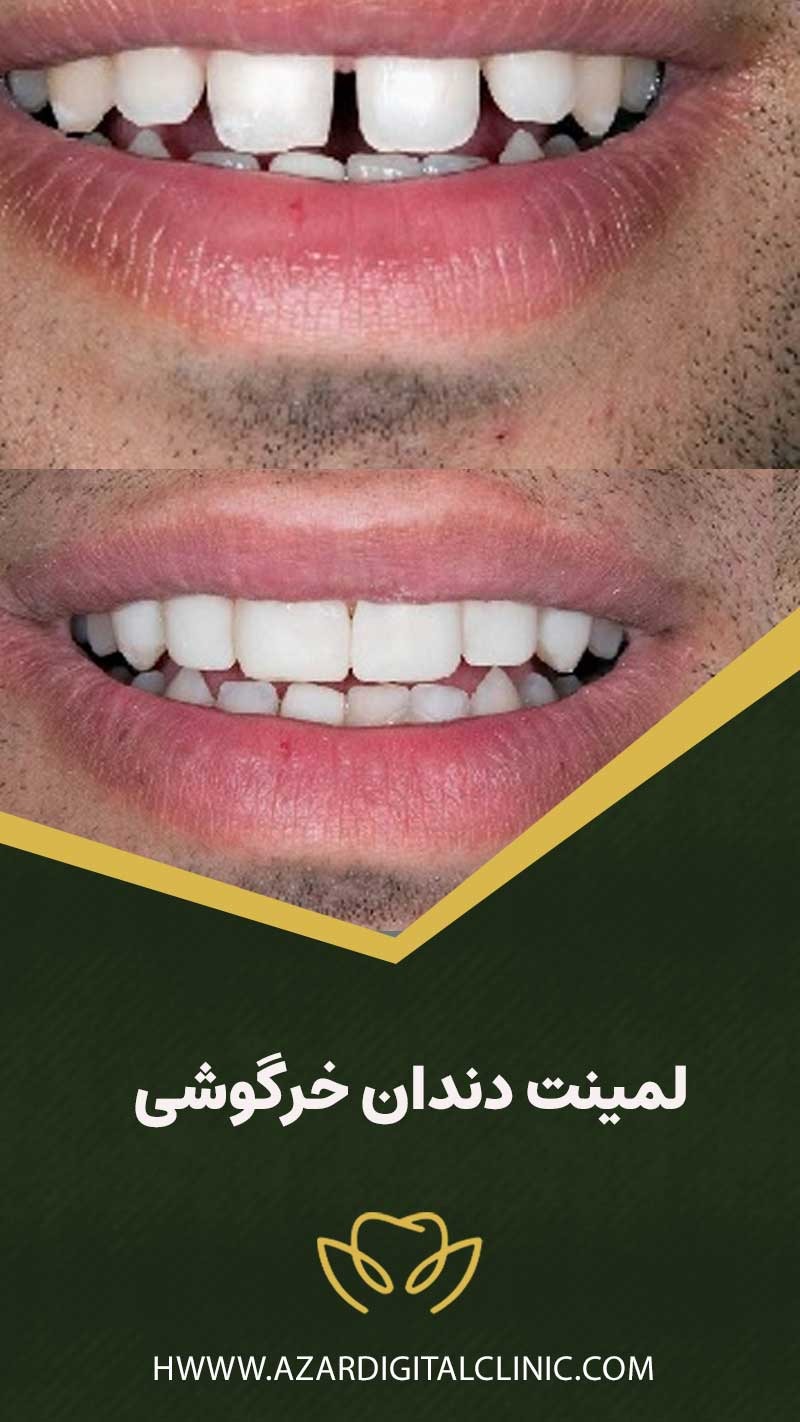 لمينت دندان خرگوشی