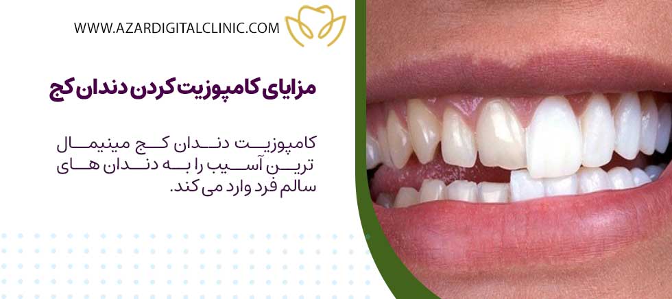 مزایای کامپوزیت کردن دندان کج