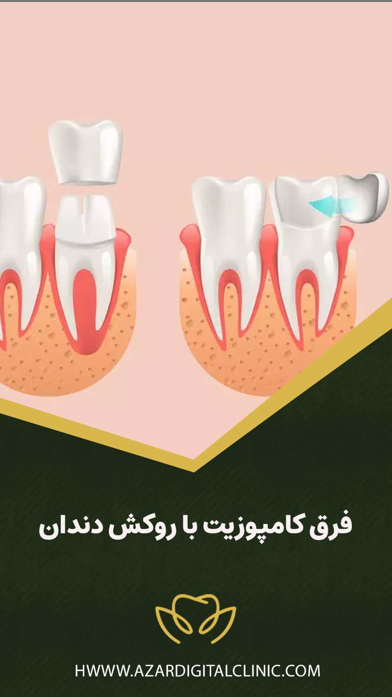 فرق کامپوزیت با روکش دندان چیست؟ کدام بهتر است؟