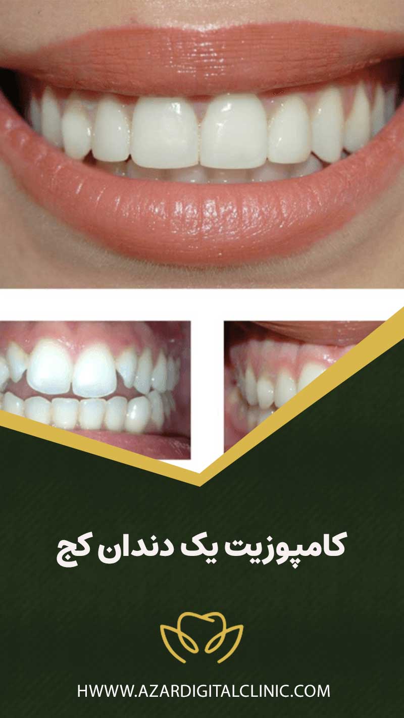 كامپوزيت يک دندان كج