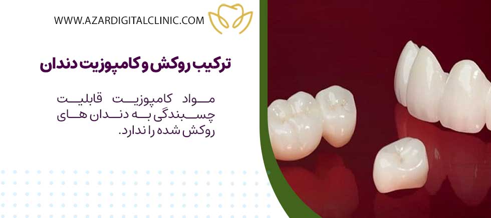 ترکیب روکش و کامپوزیت