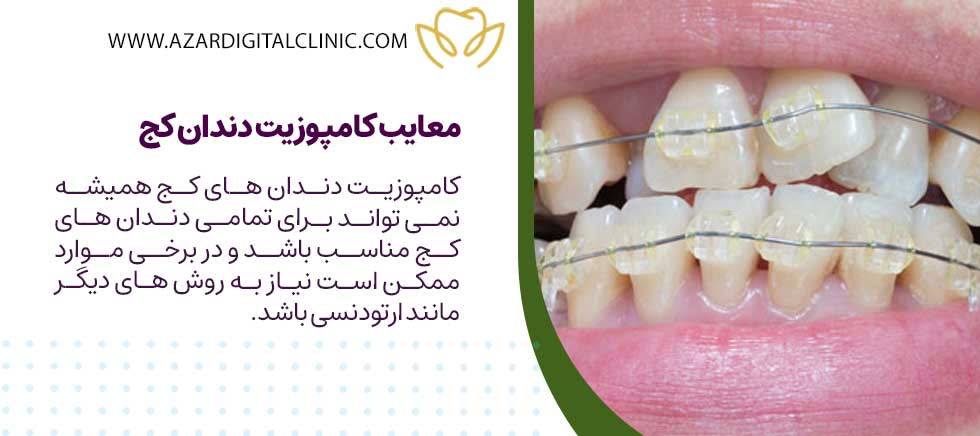 معایب کامپوزیت دندان کج