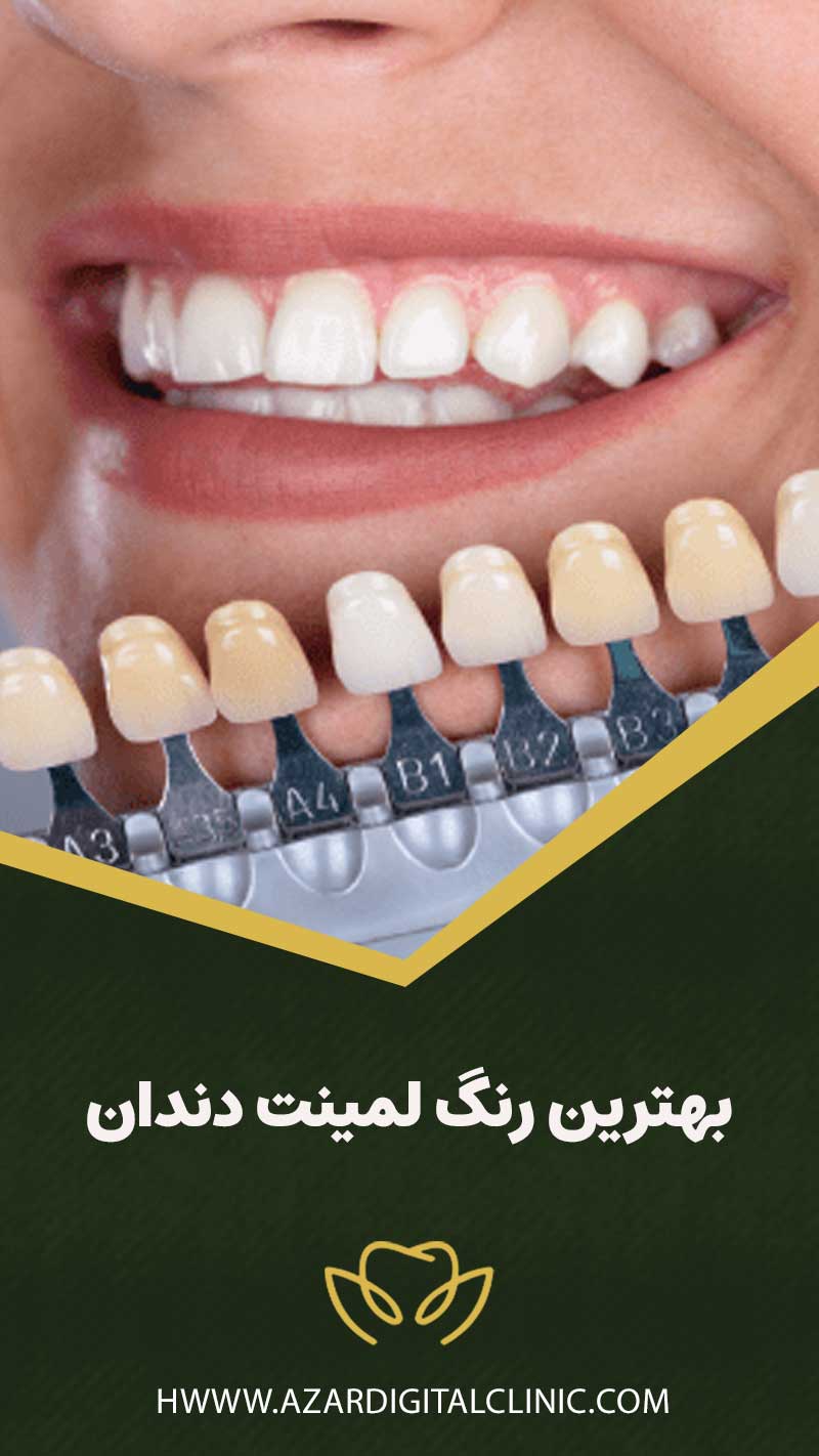 بهترین رنگ لمینت دندان را بر چه اساسی باید انتخاب کرد؟