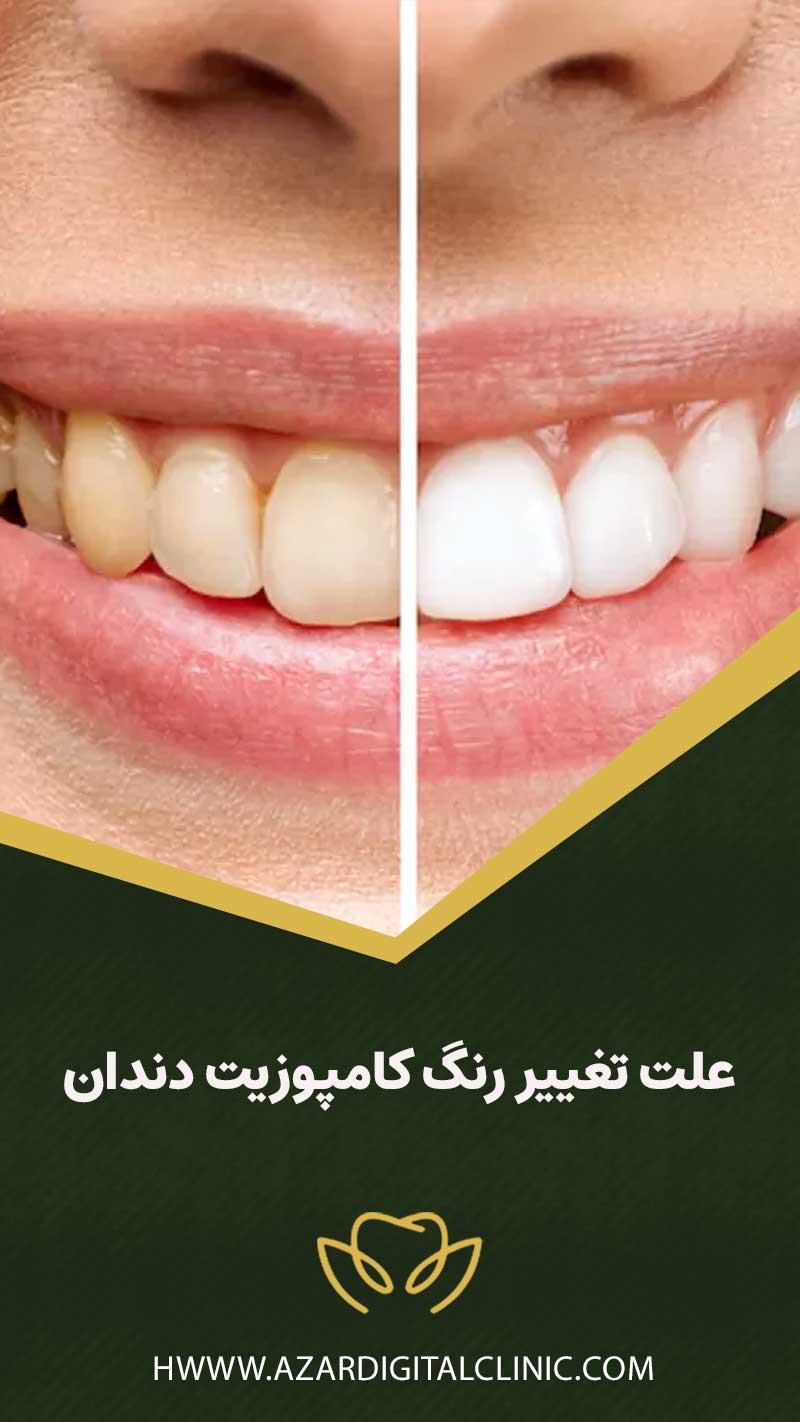 علت تغيير رنگ كامپوزيت دندان چیست؟