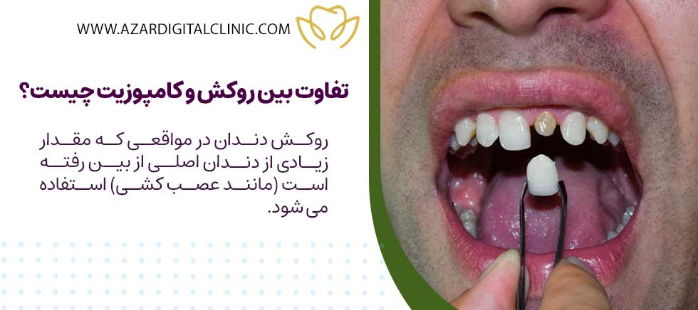 تفاوت بین روکش و کامپوزیت چیست؟
