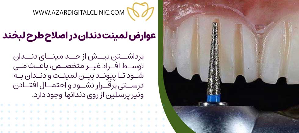 عوارض لمینت سرامیکی دندان در اصلاح طرح لبخند
