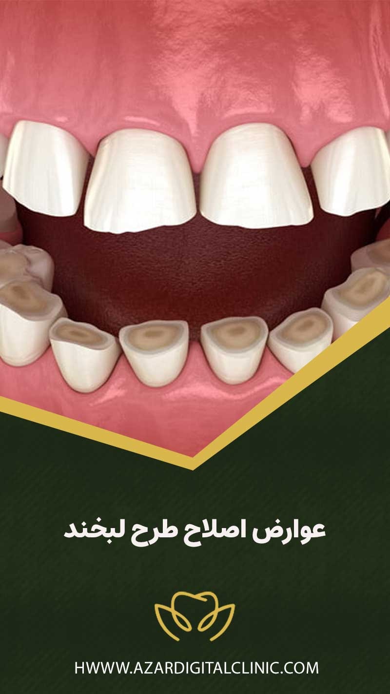 عوارض اصلاح طرح لبخند