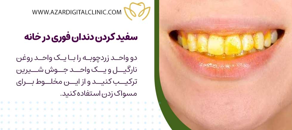سفید کردن دندان فوری در خانه