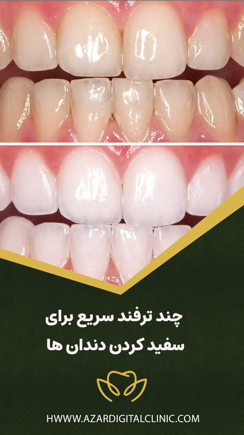 5 ترفند سريع برای سفيد كردن دندان ها