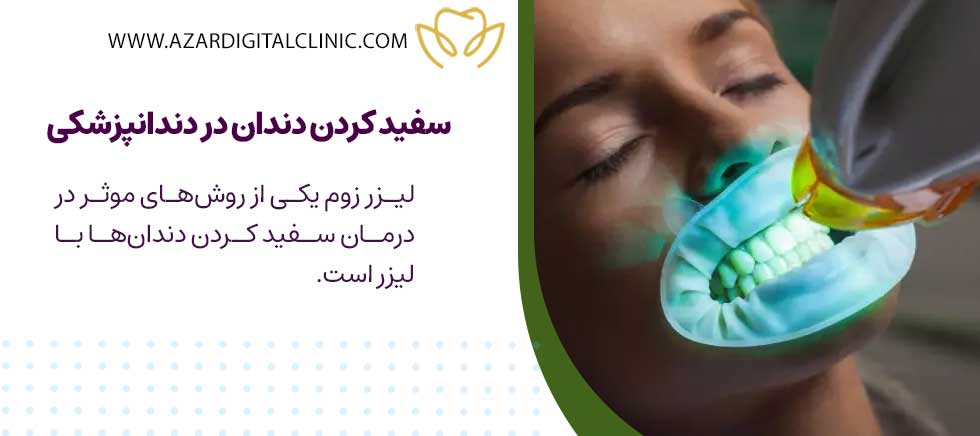 Teeth whitening in dentistry