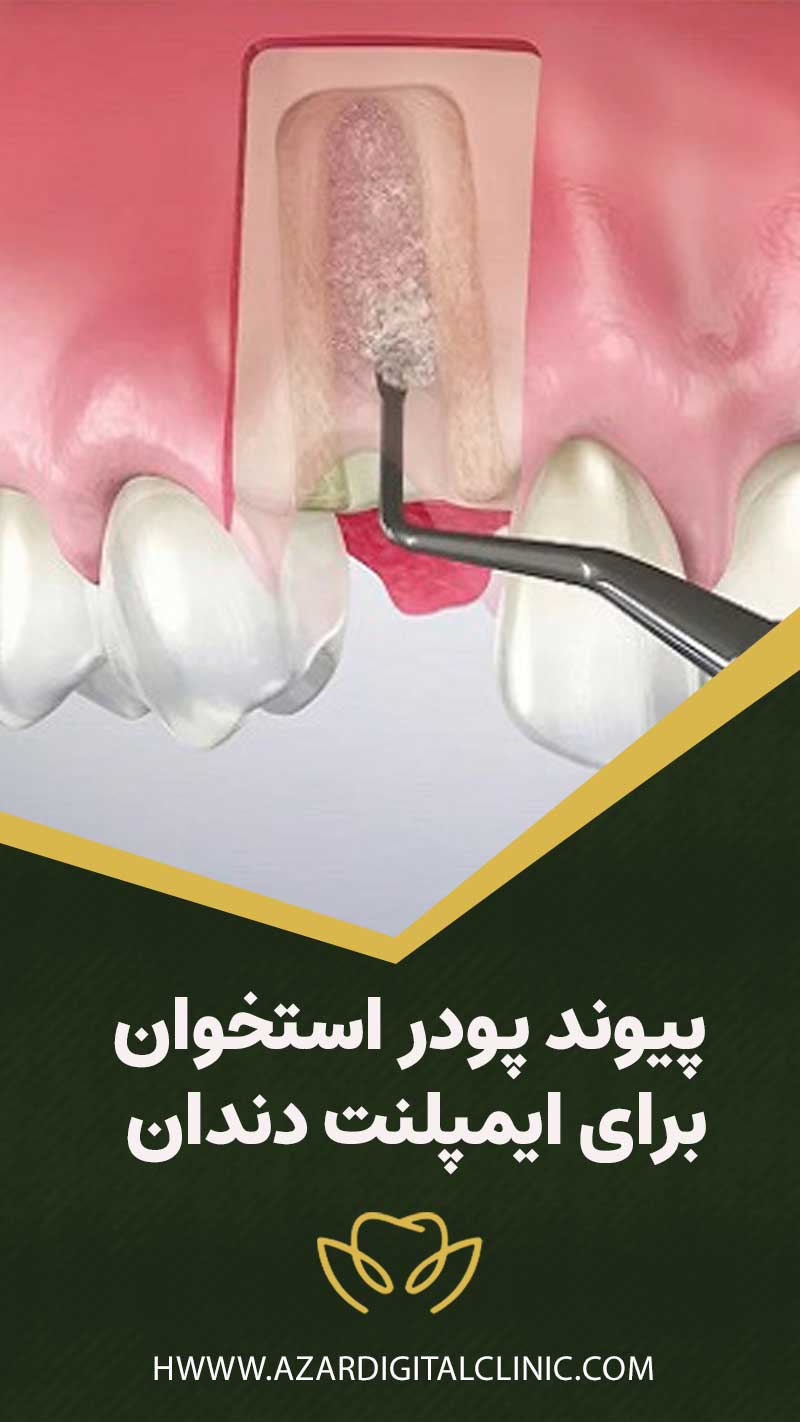 پیوند پودر استخوان برای ایمپلنت دندان