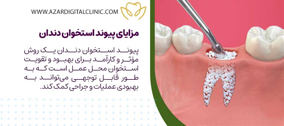 مزایای پیوند استخوان دندان چیست؟
