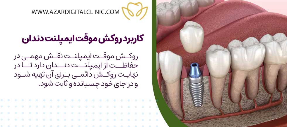 روکش موقت دندان ایمپلنت چیست و چه کاربردی دارد؟