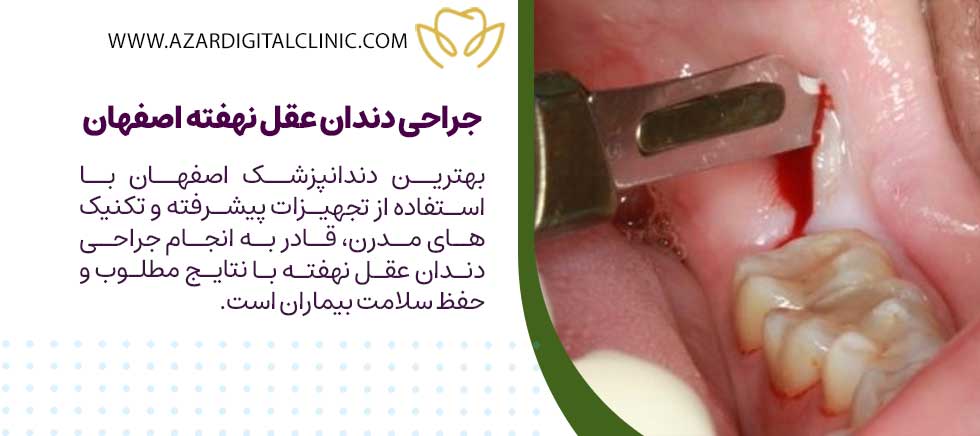 جراحی دندان عقل نهفته اصفهان