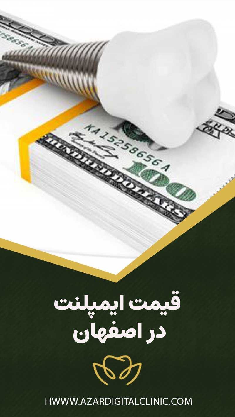 Implant-price-in-Isfahan
