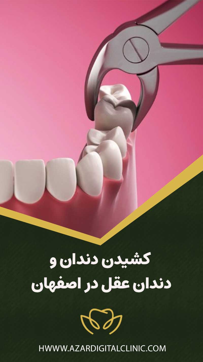 کشیدن دندان و دندان عقل در اصفهان