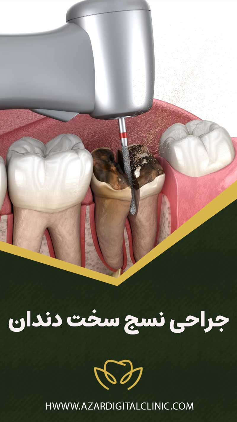 جراحی نسج سخت دندان چیست؟