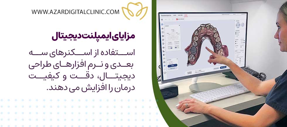 مزایای ایمپلنت دیجیتال
