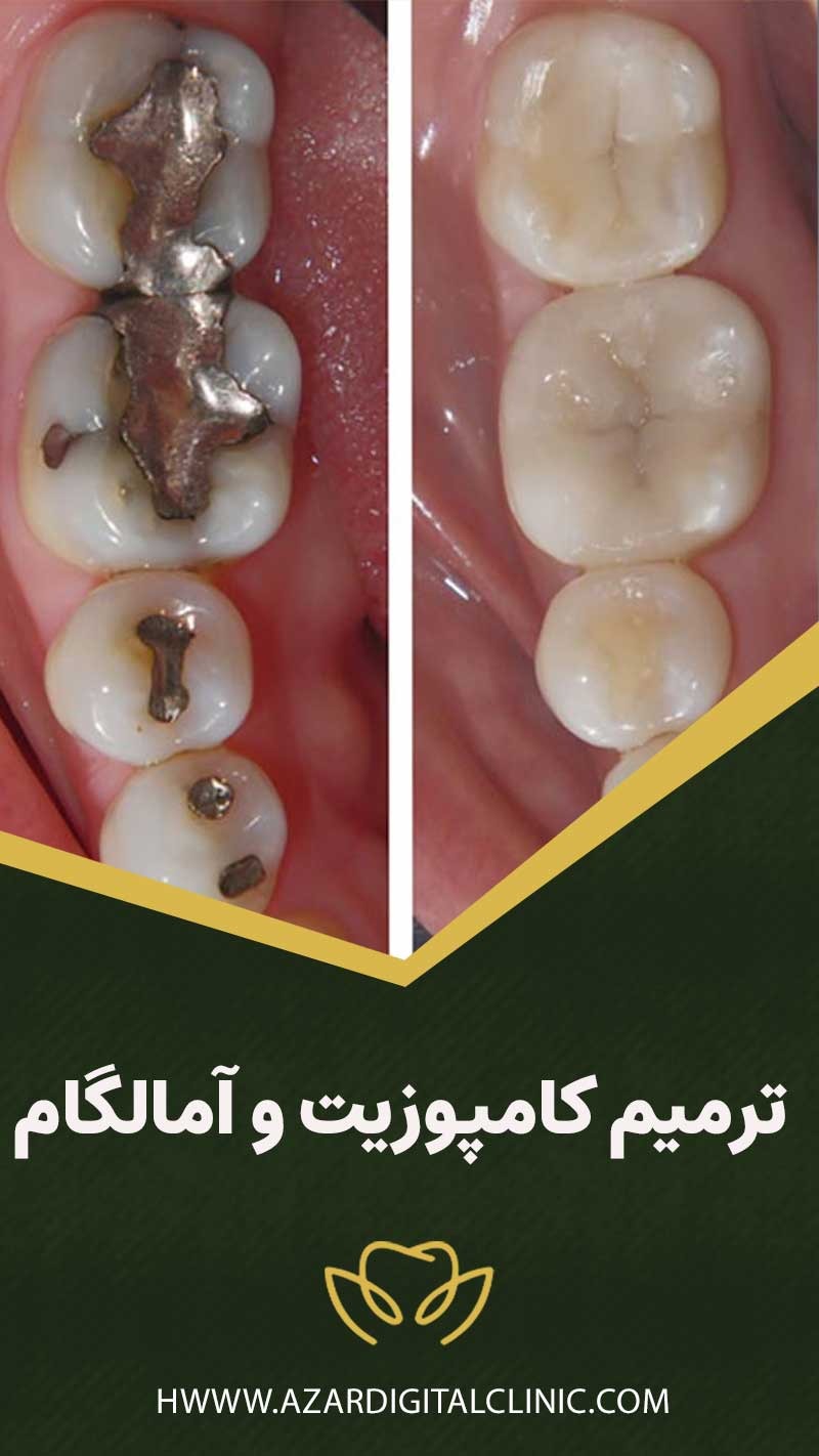 ترمیم کامپوزیت و آمالگام