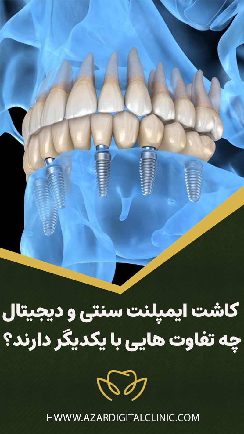 کاشت ایمپلنت سنتی و دیجیتال چه تفاوت هایی دارد؟