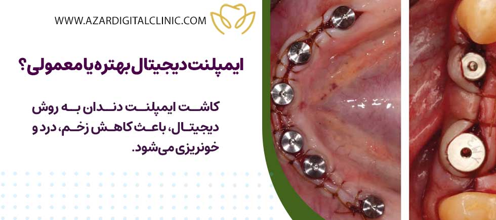 ایمپلنت دیجیتال بهتره یا معمولی؟