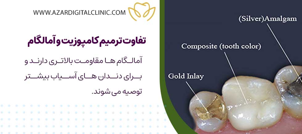 تفاوت ترمیم کامپوزیت و آمالگام