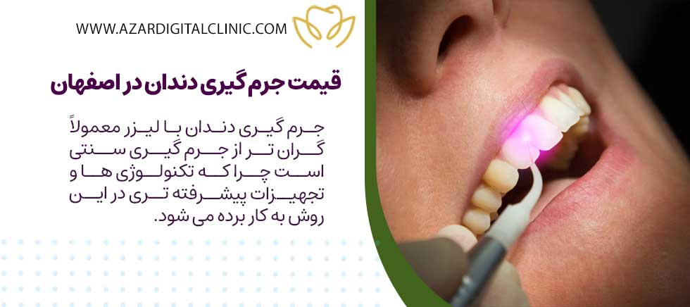 قیمت جرم گیری دندان در اصفهان