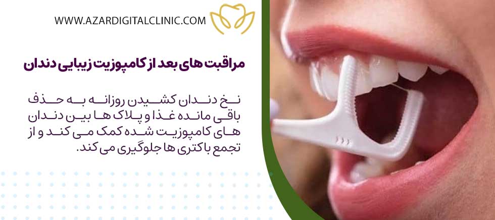 مراقبت های بعد از کامپوزیت زیبایی دندان