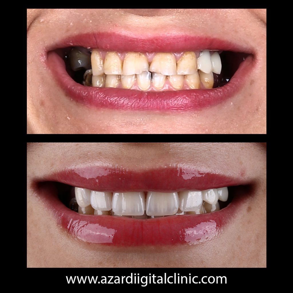 نمونه درمان لمینیت سرامیکی در اصفهان در مرکز دندانپزشکی دیجیتال آذر در اصفهان