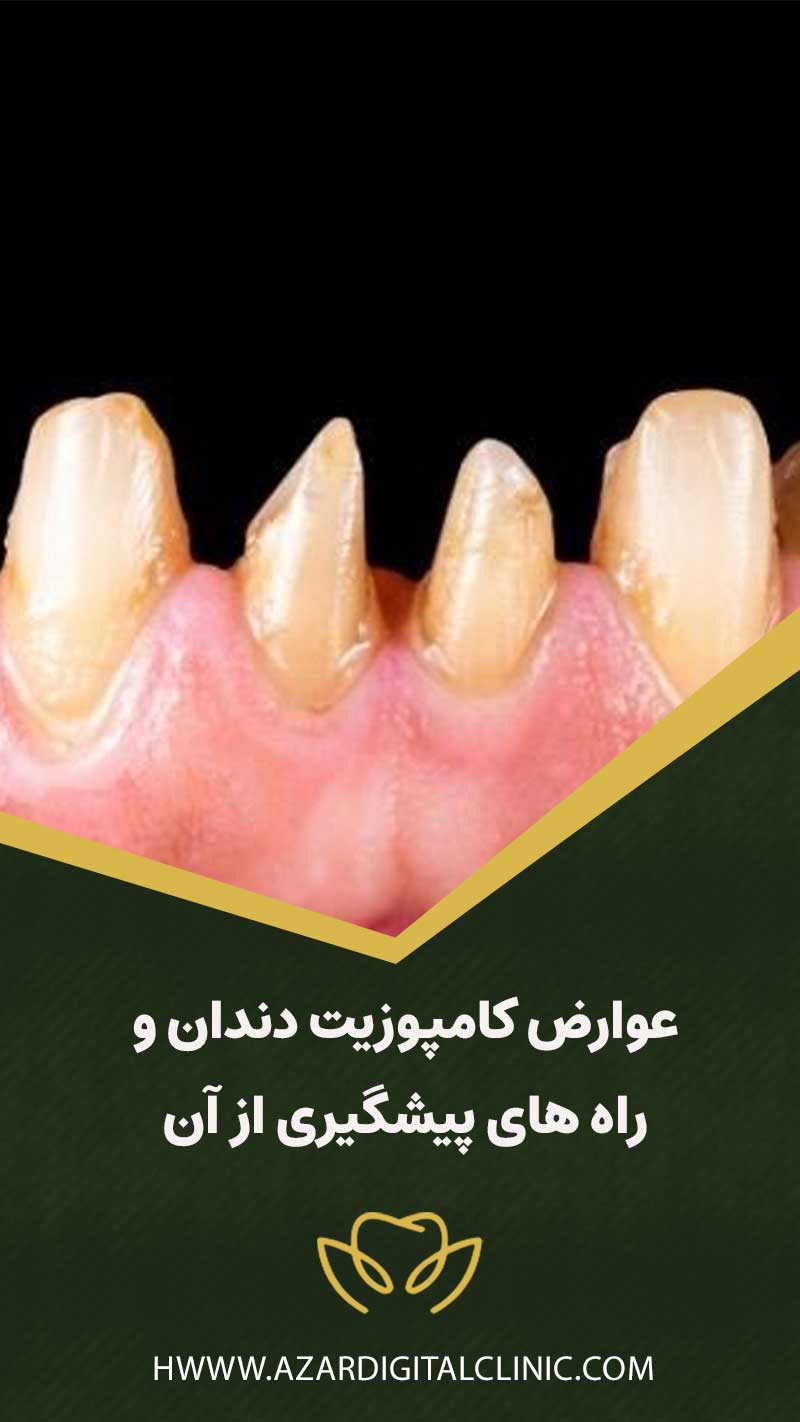عوارض کامپوزیت دندان و راه های پیشگیری از آن