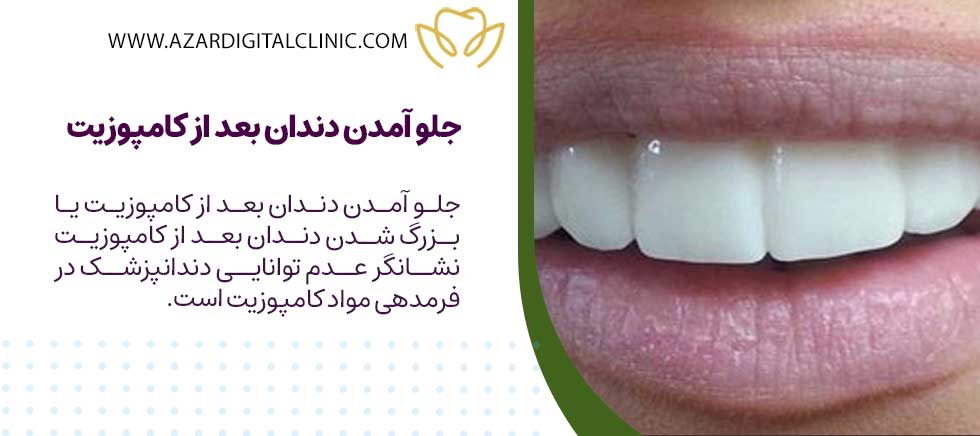 جلو آمدن دندان بعد از کامپوزیت