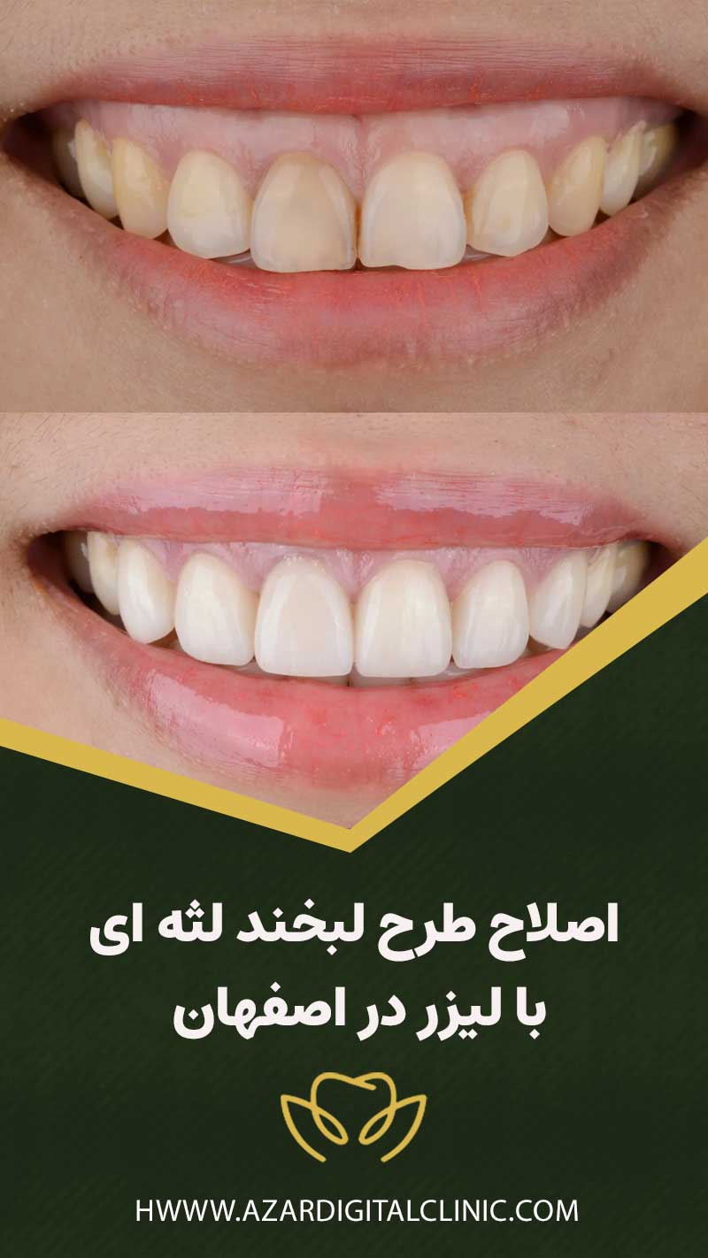 اصلاح طرح لبخند لثه ای با ليزر در اصفهان| بهترين روش درمان+مزايا