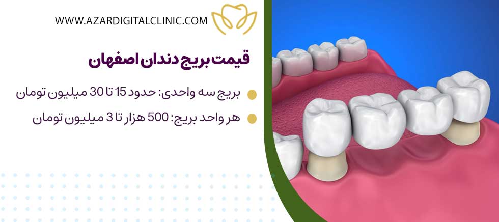 هزینه بریج دندان در اصفهان