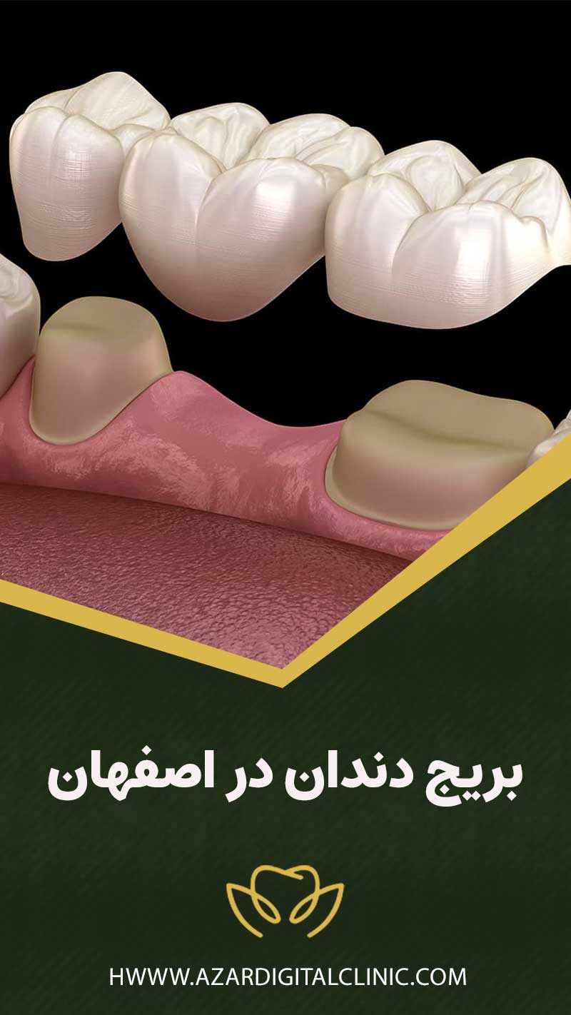 بريج دندان در اصفهان