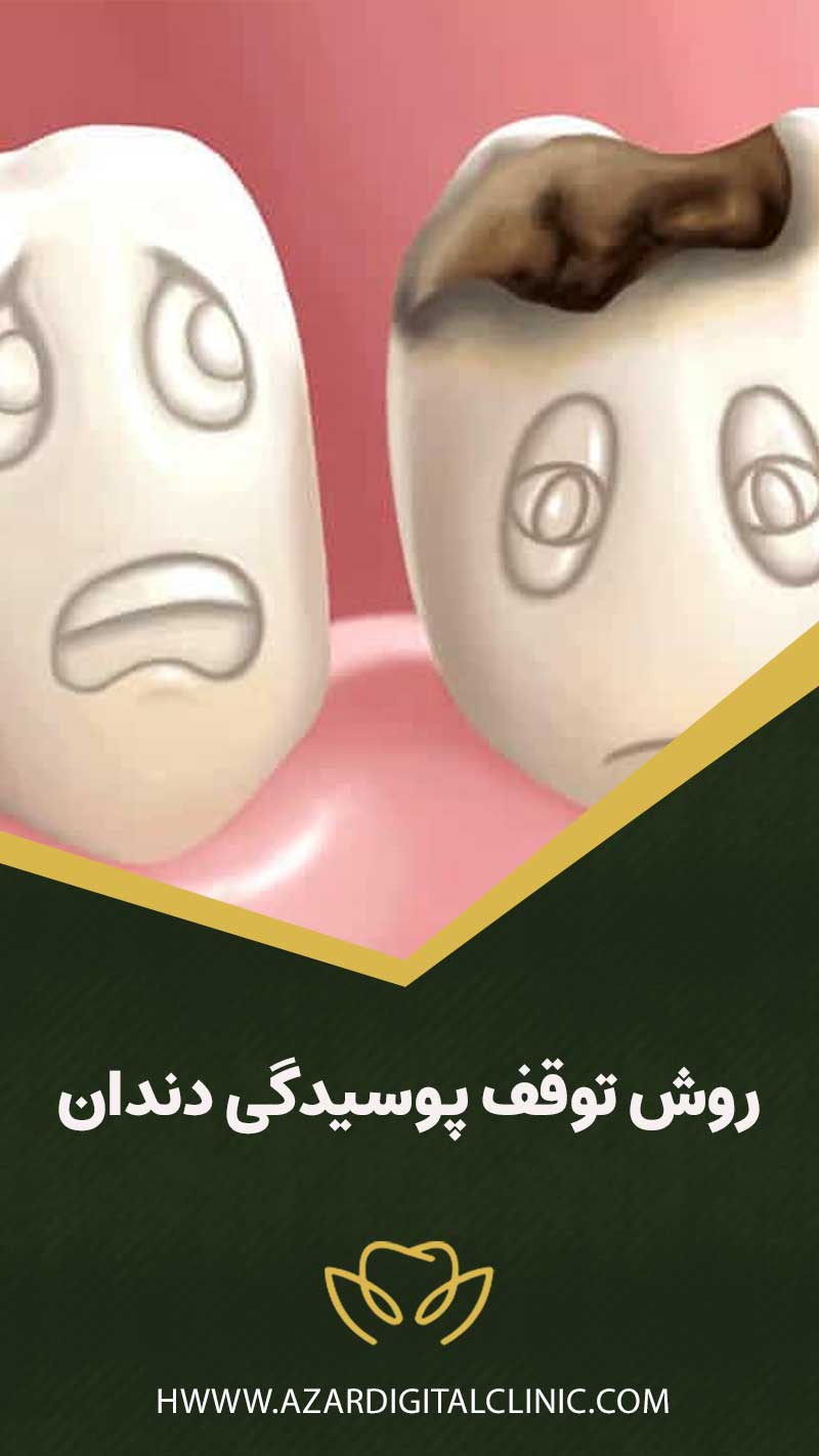 روش توقف پوسیدگی دندان