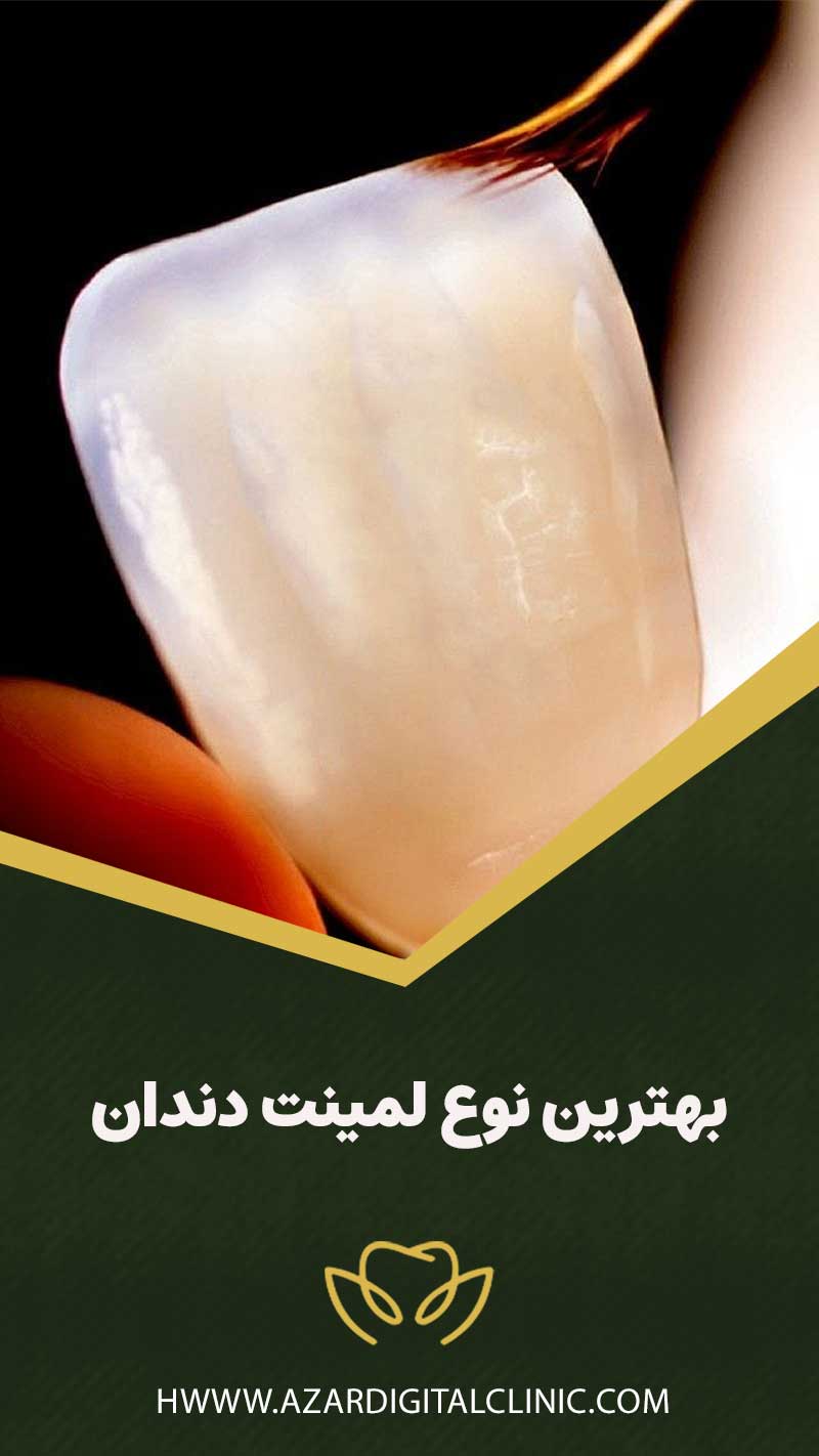 بهترین نوع لمینت دندان چیست؟