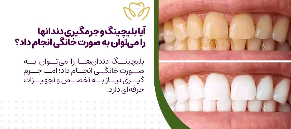 آیا بلیچینگ و جرمگیری دندانها را میتوان به صورت خانگی انجام داد؟
