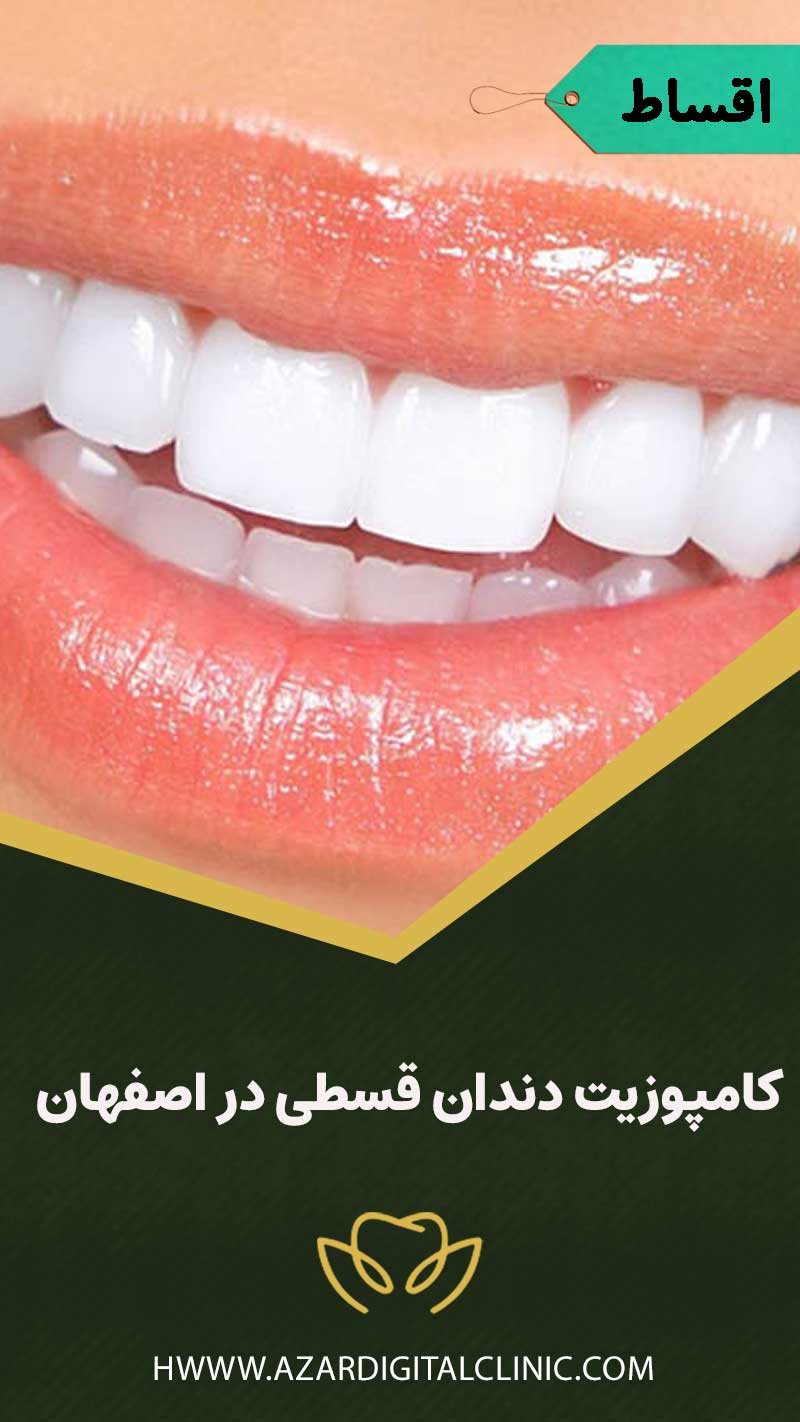 کامپوزیت دندان قسطی در اصفهان