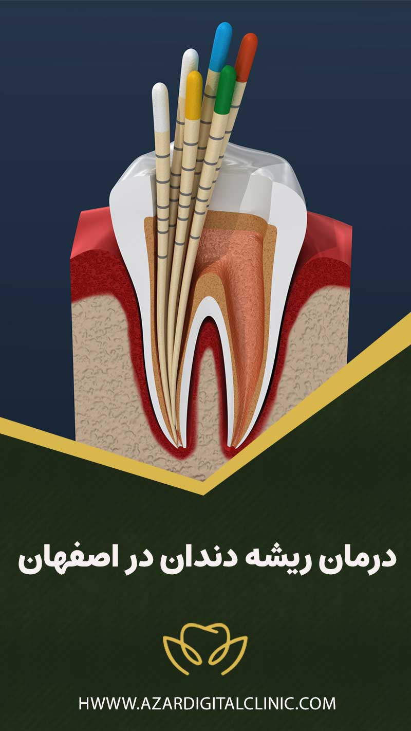 درمان ریشه دندان در اصفهان