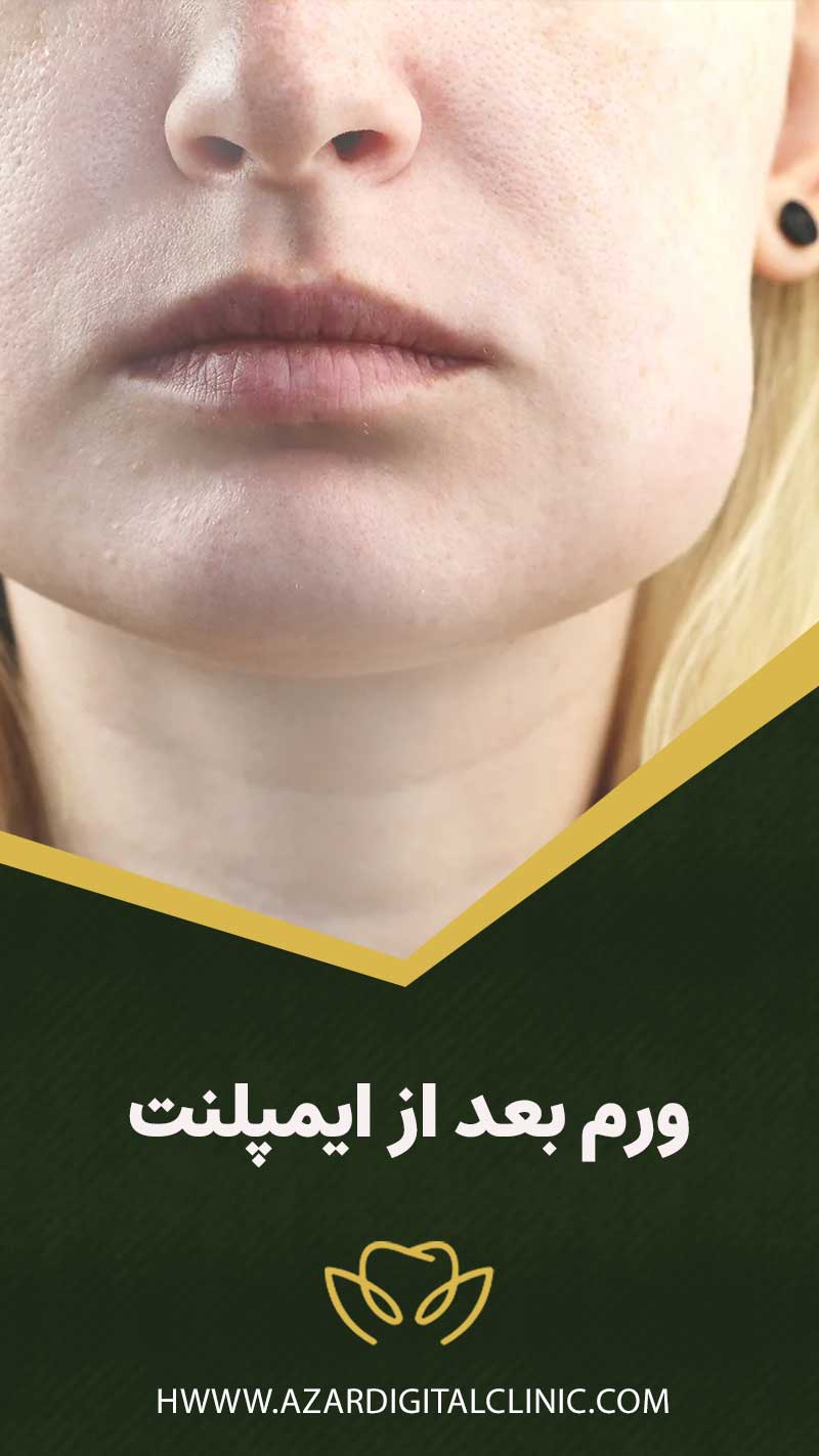 ورم بعد از ایمپلنت