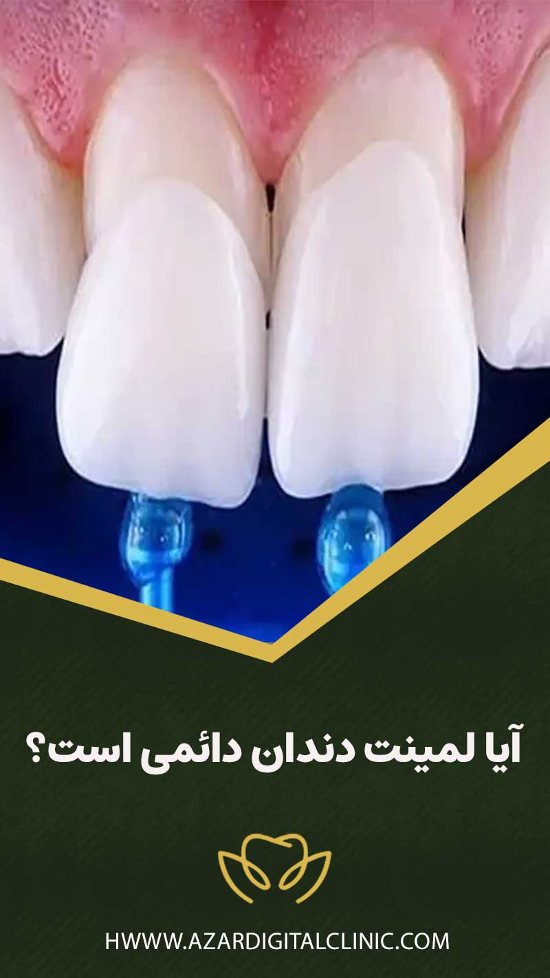 آیا لمینت دندان دائمی است؟