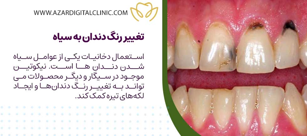 تغییر رنگ دندان به سیاه