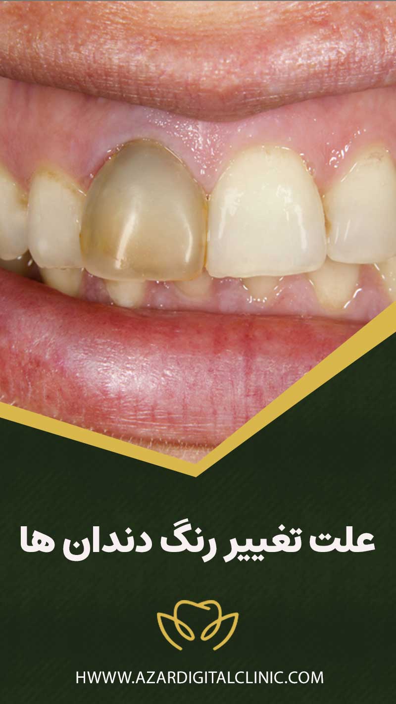 علت تغيير رنگ دندان ها چیست؟