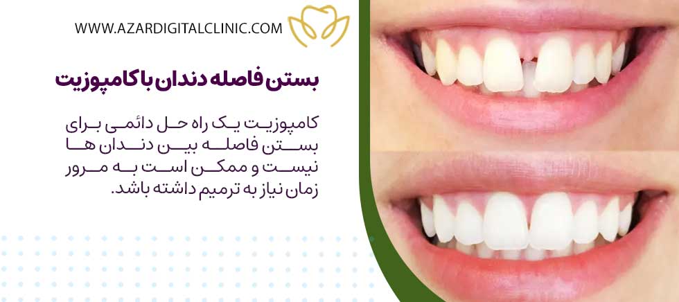 بستن فاصله دندان با کامپوزیت